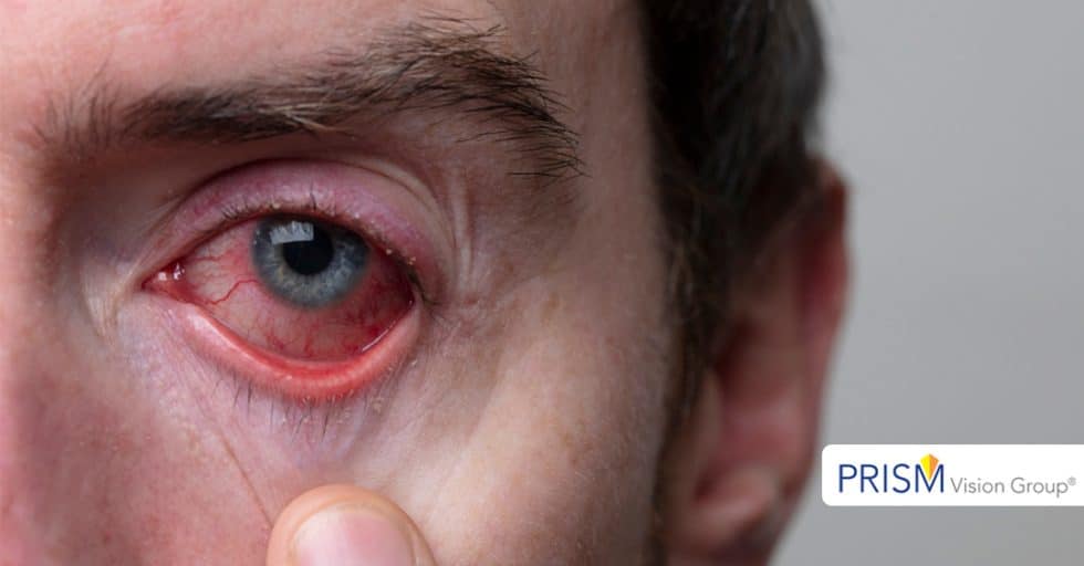 The Dangers of “Redness Relief” Eye Drops Eye Associates