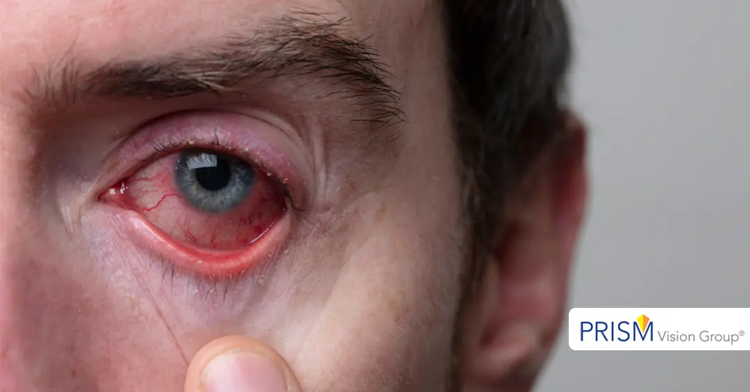The Dangers of “Redness Relief” Eye Drops