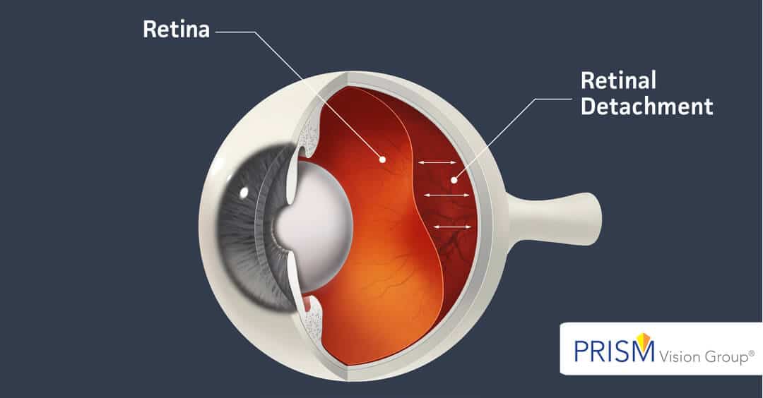 What Is a Detached Retina?