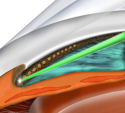 slt glaucoma laser eye associates