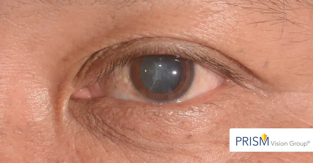 Cataracts Don’t Return: Facts You Might Not Know