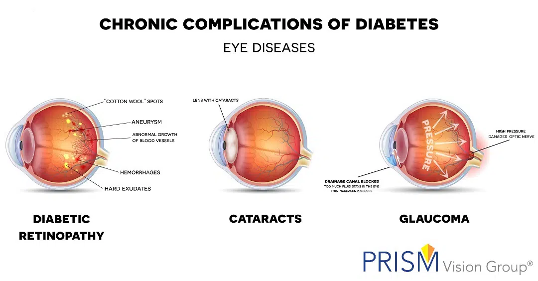 Cataracts & Diabetes: Facts You Might Not Know